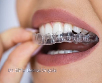 Invisalign treatment