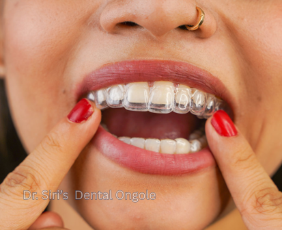 Clear aligners