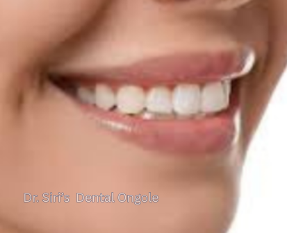 Porcelain Veneers Result
