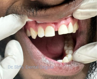 Tooth Colored Filling